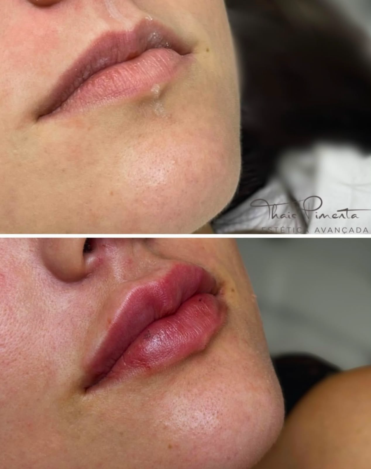 Preenchimento Labial - Antes e Depois